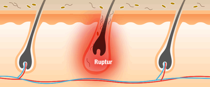 Ruptur