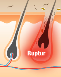  Rupture